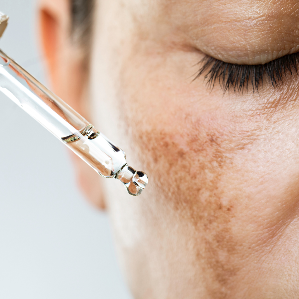 Hydroquinone treatment for hyperpigmentation compounded in McKinney, TX at Medrocs Pharmacy